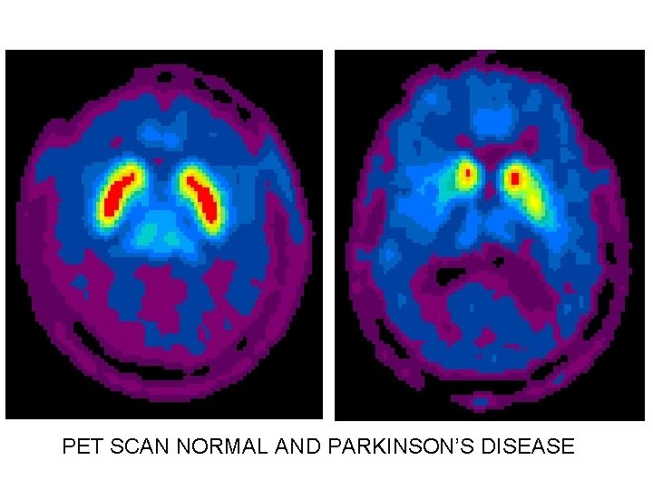 PET SCAN NORMAL AND PARKINSON’S DISEASE 