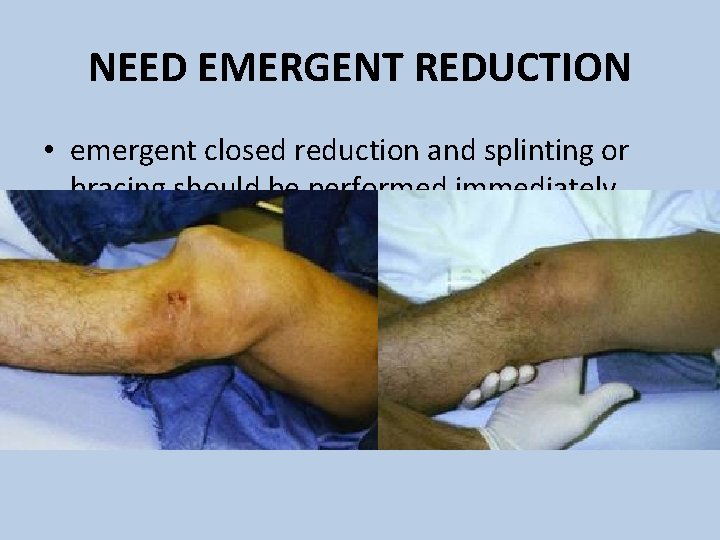 NEED EMERGENT REDUCTION • emergent closed reduction and splinting or bracing should be performed