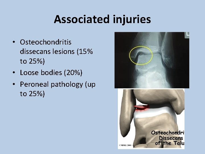 Associated injuries • Osteochondritis dissecans lesions (15% to 25%) • Loose bodies (20%) •