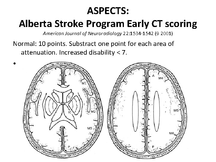 ASPECTS: Alberta Stroke Program Early CT scoring American Journal of Neuroradiology 22: 1534 -1542