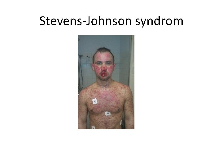 Stevens-Johnson syndrom 