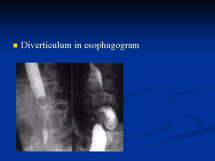 n Diverticulum in esophagogram 