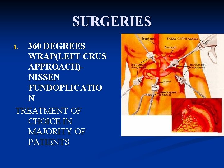 SURGERIES 360 DEGREES WRAP(LEFT CRUS APPROACH)NISSEN FUNDOPLICATIO N TREATMENT OF CHOICE IN MAJORITY OF