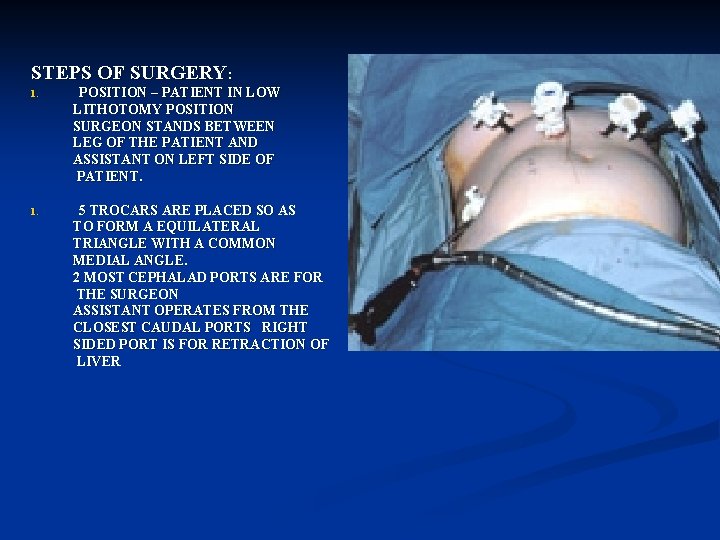 STEPS OF SURGERY: 1. POSITION – PATIENT IN LOW LITHOTOMY POSITION SURGEON STANDS BETWEEN