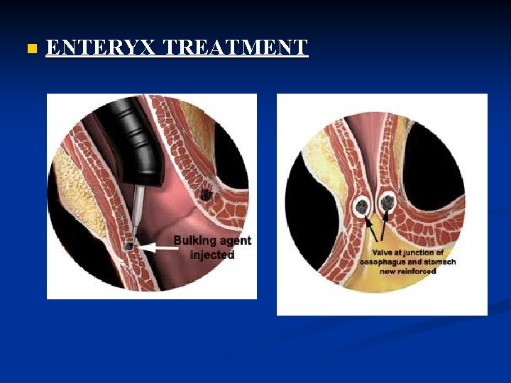 n ENTERYX TREATMENT 