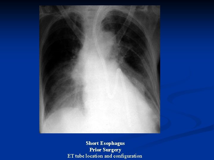 Short Esophagus Prior Surgery ET tube location and configuration 
