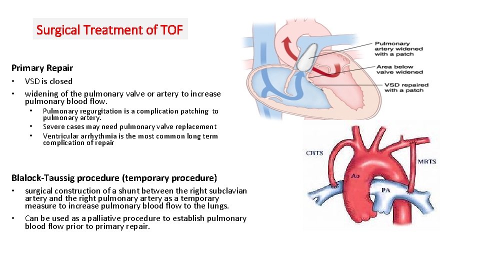 Surgical Treatment of TOF Primary Repair • • VSD is closed widening of the
