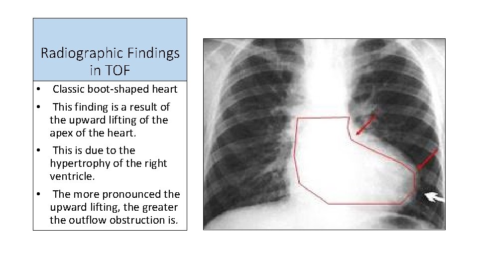 Radiographic Findings in TOF • Classic boot-shaped heart • This finding is a result