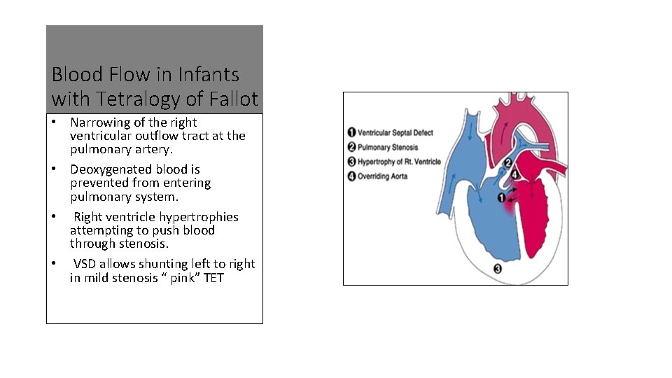 Blood Flow in Infants with Tetralogy of Fallot • Narrowing of the right ventricular