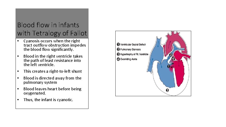 Blood flow in infants with Tetralogy of Fallot • • • Cyanosis occurs when