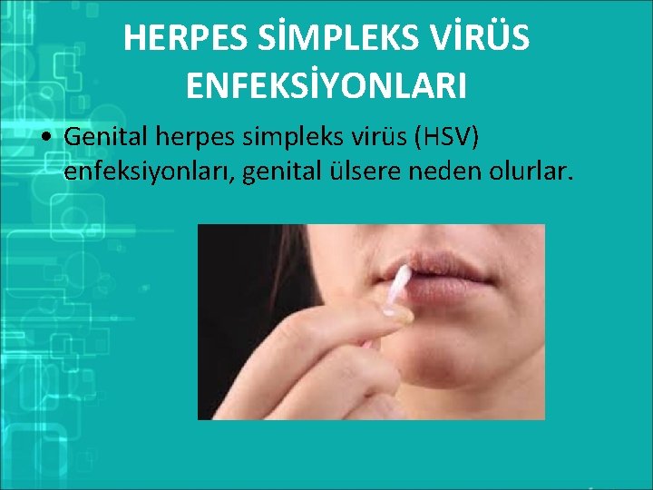 HERPES SİMPLEKS VİRÜS ENFEKSİYONLARI • Genital herpes simpleks virüs (HSV) enfeksiyonları, genital ülsere neden