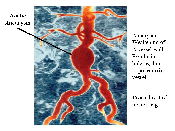 Aortic Aneurysm: Weakening of A vessel wall; Results in bulging due to pressure in