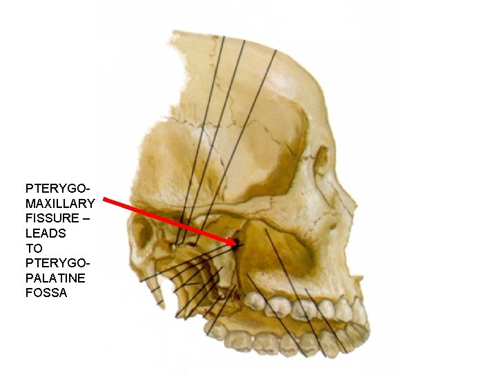 PTERYGOMAXILLARY FISSURE – LEADS TO PTERYGOPALATINE FOSSA 