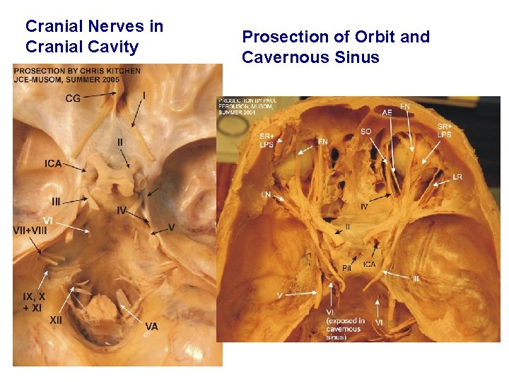 Cranial Nerves in Cranial Cavity Prosection of Orbit and Cavernous Sinus 