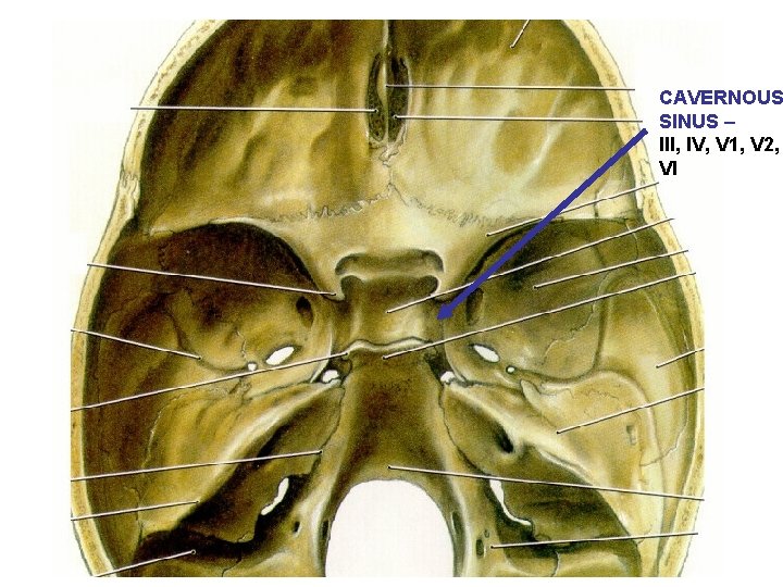 CAVERNOUS SINUS – III, IV, V 1, V 2, VI 