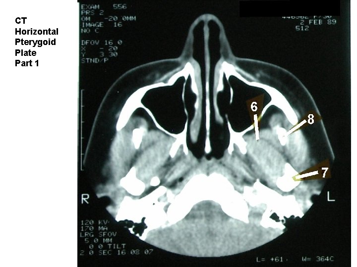 CT Horizontal Pterygoid Plate Part 1 