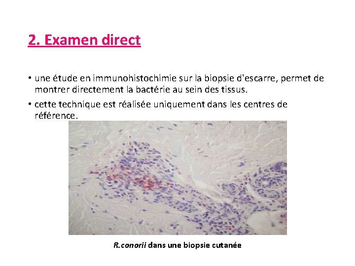 2. Examen direct • une étude en immunohistochimie sur la biopsie d'escarre, permet de