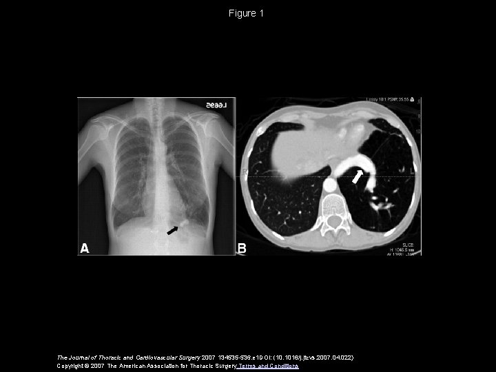 Figure 1 The Journal of Thoracic and Cardiovascular Surgery 2007 134535 -536. e 1