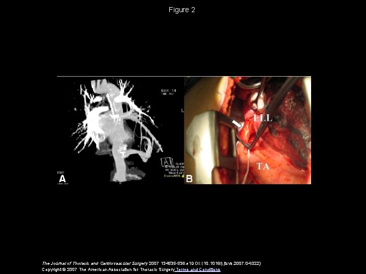 Figure 2 The Journal of Thoracic and Cardiovascular Surgery 2007 134535 -536. e 1