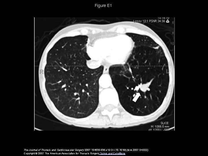 Figure E 1 The Journal of Thoracic and Cardiovascular Surgery 2007 134535 -536. e