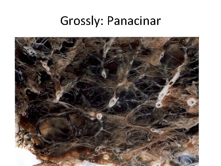 Grossly: Panacinar 