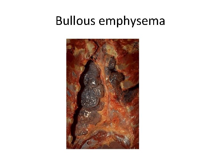 Bullous emphysema 