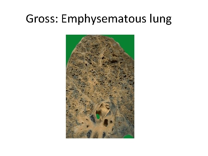 Gross: Emphysematous lung 