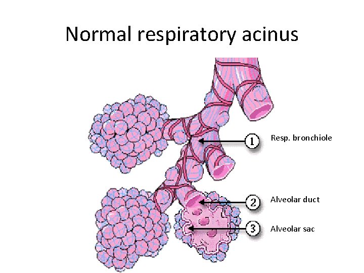 Normal respiratory acinus Resp. bronchiole Alveolar duct Alveolar sac 