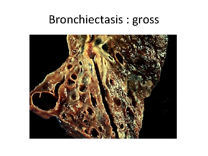 Bronchiectasis : gross 