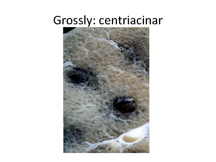 Grossly: centriacinar 