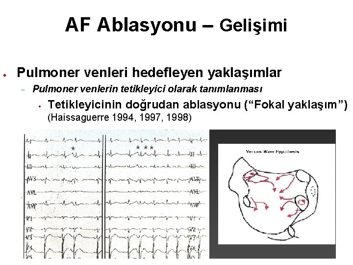 AF Ablasyonu – Gelişimi Pulmoner venleri hedefleyen yaklaşımlar Pulmoner venlerin tetikleyici olarak tanımlanması Tetikleyicinin