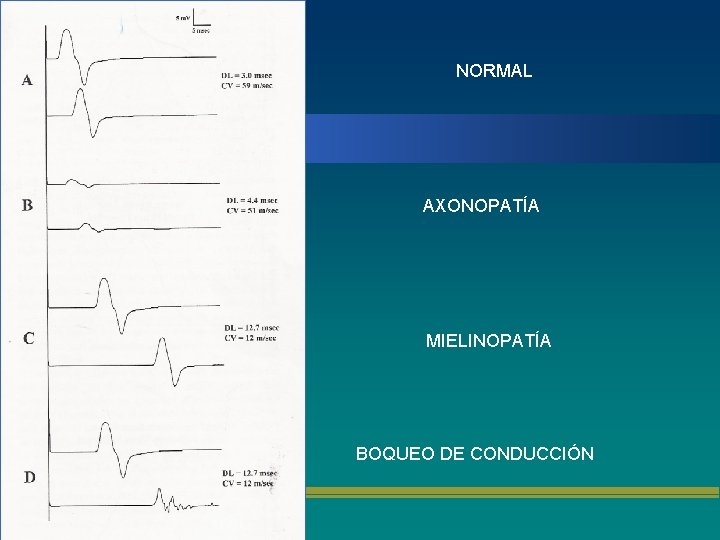 NORMAL AXONOPATÍA MIELINOPATÍA BOQUEO DE CONDUCCIÓN 