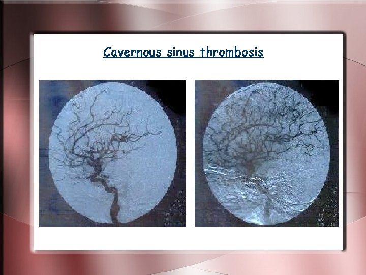 Cavernous sinus thrombosis Cavernous sinus thrombosis