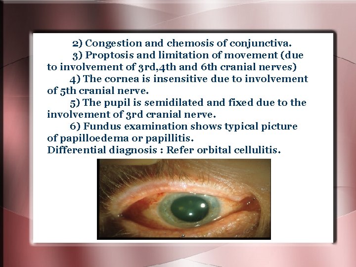 2) Congestion and chemosis of conjunctiva. 3) Proptosis and limitation of movement (due to 2) Congestion and chemosis of conjunctiva. 3) Proptosis and limitation of movement (due to