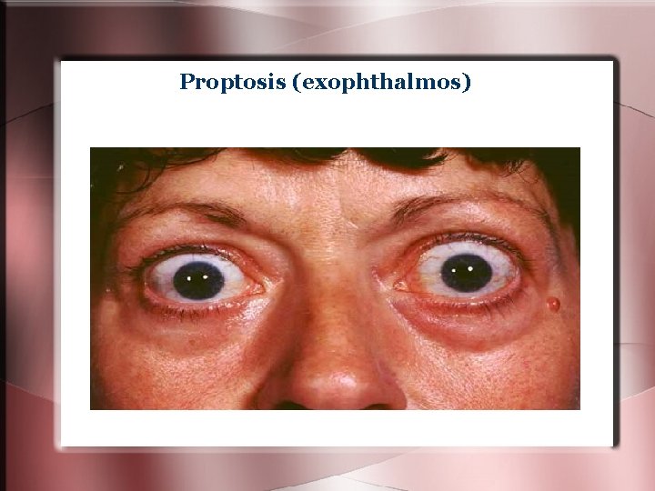 Proptosis (exophthalmos) Proptosis (exophthalmos)