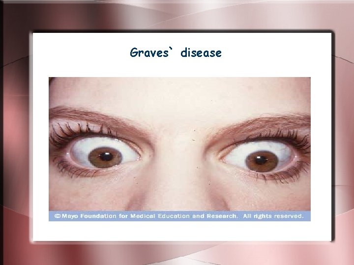 Graves` disease Graves` disease