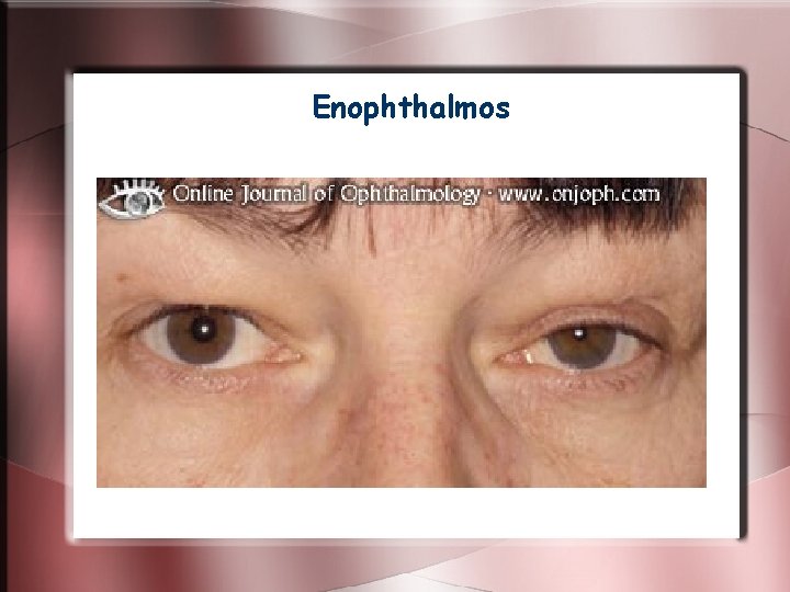 Enophthalmos Enophthalmos