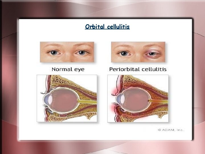 Orbital cellulitis Orbital cellulitis