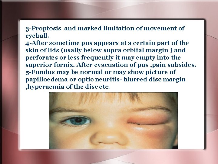 3 -Proptosis and marked limitation of movement of eyeball. 4 -After sometime pus appears 3 -Proptosis and marked limitation of movement of eyeball. 4 -After sometime pus appears