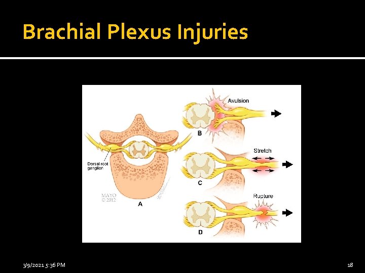 Brachial Plexus Injuries 3/9/2021 5: 36 PM 18 