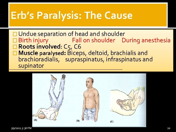 Erb’s Paralysis: The Cause � Undue separation of head and shoulder � Birth injury