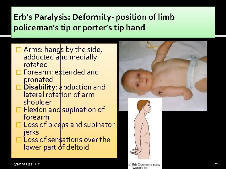 Erb’s Paralysis: Deformity- position of limb policeman’s tip or porter’s tip hand � Arms: