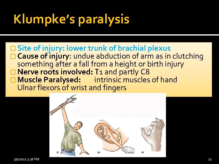 Klumpke’s paralysis � Site of injury: lower trunk of brachial plexus � Cause of