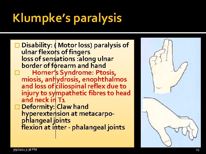 Klumpke’s paralysis � Disability: ( Motor loss) paralysis of ulnar flexors of fingers loss