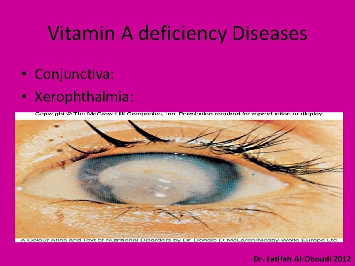 Vitamin A deficiency Diseases • Conjunctiva: • Xerophthalmia: Dr. Latifah Al-Oboudi 2012 