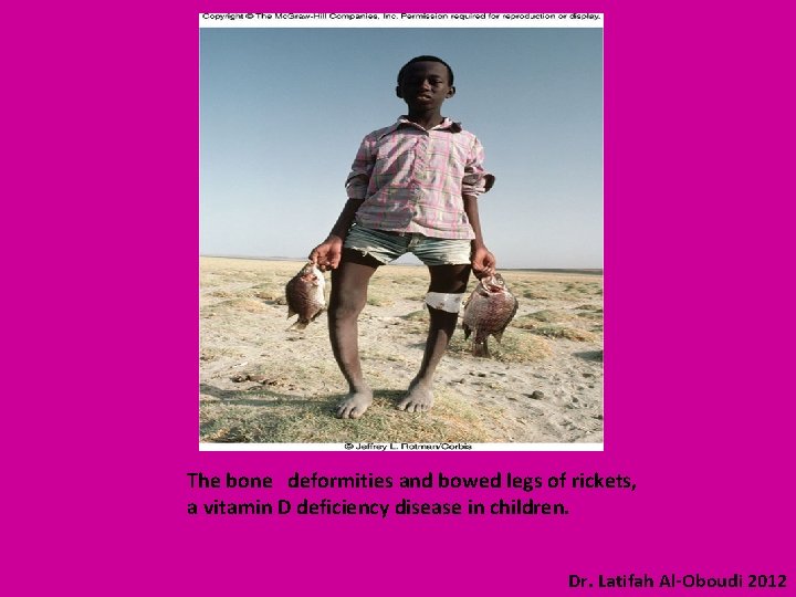 The bone deformities and bowed legs of rickets, a vitamin D deficiency disease in