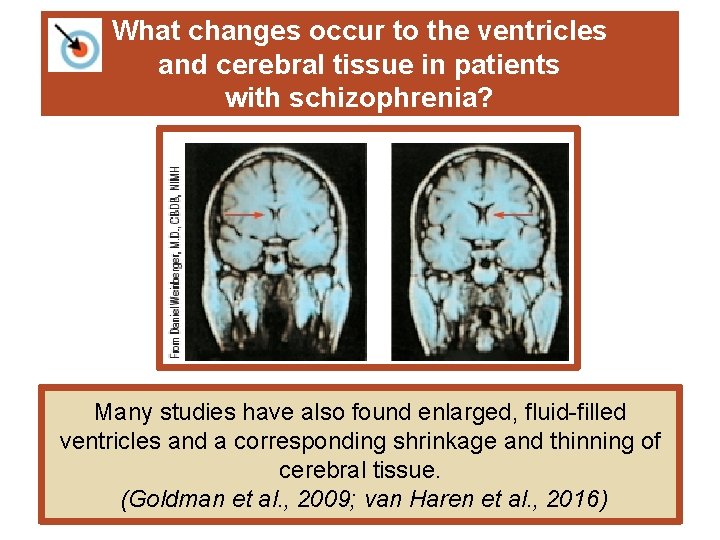 What changes occur to the ventricles and cerebral tissue in patients with schizophrenia? Many