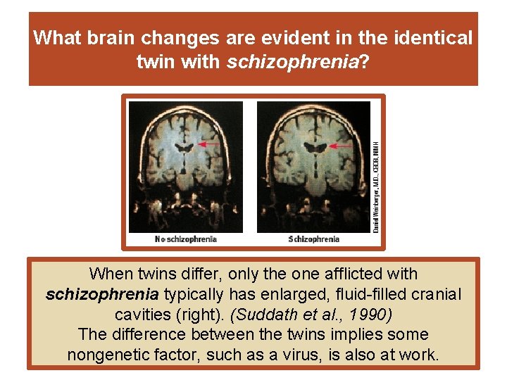 What brain changes are evident in the identical twin with schizophrenia? When twins differ,
