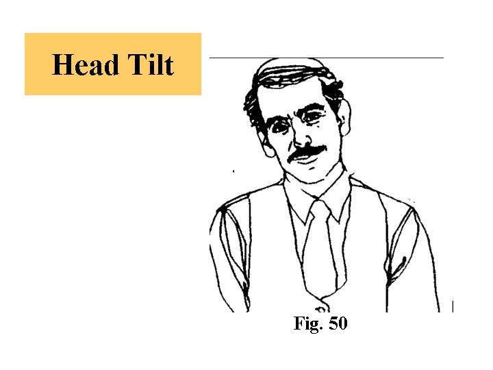 Head Tilt Fig. 50 
