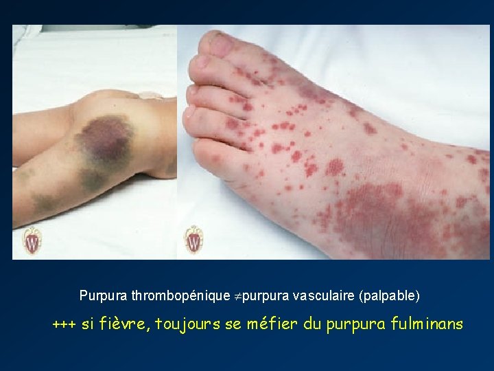 Purpura thrombopénique purpura vasculaire (palpable) +++ si fièvre, toujours se méfier du purpura fulminans